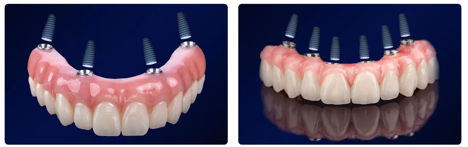 All-on-4 y All-on-6 — dientes fijos sobre implantes